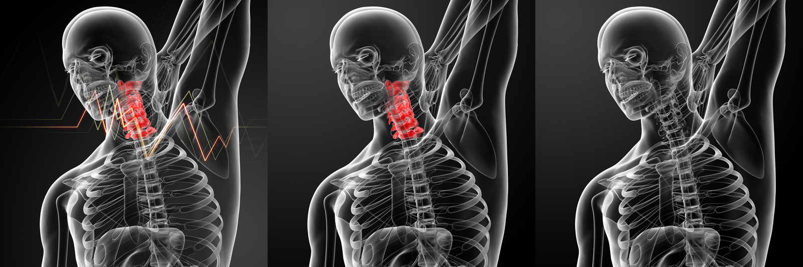 whiplash and back pain compensation
